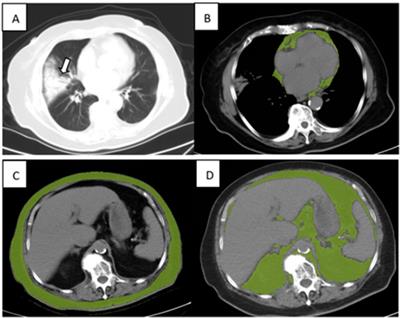 Subcutaneous adipose tissue measured by computed tomography could be an independent predictor for early outcomes of patients with severe COVID-19